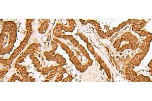 Immunohistochemistry of paraffin-embedded Human thyroid cancer tissue using GMEB2 Polyclonal Antibody at dilution of 1:35(x200) (GMEB2 抗体)
