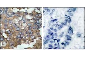 Immunohistochemistry analysis of paraffin-embedded human breast carcinoma tissue, using Src (Ab-529) Antibody. (Src 抗体  (AA 487-536))