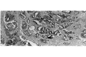 Immunohistochemical staining  of human gastric carcinoma tissue using MMP-3 antibody . (MMP3 抗体  (C-Term))