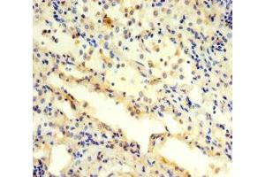 Immunohistochemistry of paraffin-embedded human lung cancer using ABIN7142230 at dilution of 1:100 (PSMC3 抗体  (Regulatory Subunit 6A))