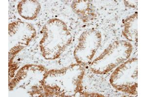 IHC-P Image Immunohistochemical analysis of paraffin-embedded human gastric cancer, using RGS14, antibody at 1:100 dilution.