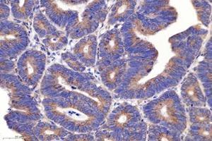 Immunohistochemistry analysis of paraffin-embedded human colon cancer using PSMD8 (ABIN7075226) at dilution of 1: 2600 (PSMD8 抗体)