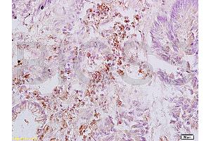 Formalin-fixed and paraffin embedded human rectal carcinoma labeled with Anti-Integrin beta 3/CD61 Polyclonal Antibody, Unconjugated (ABIN739029) at 1:200, followed by conjugation to the secondary antibody and DAB staining (Integrin beta 3 抗体  (AA 27-120))
