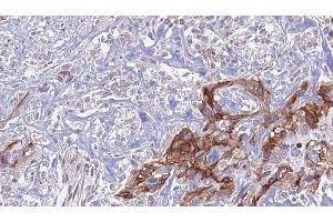 ABIN6274443 at 1/100 staining Human urothelial cancer tissue by IHC-P. (EPS8-Like 1 抗体  (Internal Region))