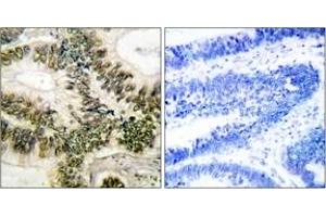 Immunohistochemistry analysis of paraffin-embedded human colon carcinoma tissue, using Cyclin E1 (Ab-395) Antibody.