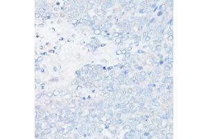 Immunohistochemistry of paraffin-embedded Human liver cancer (negative control sample) using MUC1 Rabbit mAb (ABIN7268687) at dilution of 1:100 (40x lens). (MUC1 抗体)