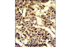 Formalin-fixed and paraffin-embedded human breast carcinoma reacted with CYP2A13 Antibody , which was peroxidase-conjugated to the secondary antibody, followed by DAB staining. (CYP2A13 抗体  (C-Term))