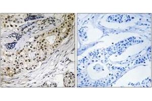 Immunohistochemistry analysis of paraffin-embedded human colon carcinoma tissue, using LAMA3 Antibody. (LAMA3 抗体  (AA 2571-2620))