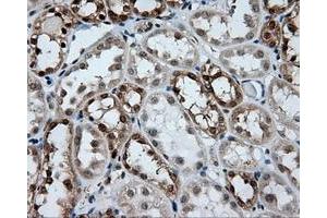 Immunohistochemical staining of paraffin-embedded Carcinoma of liver tissue using anti-GBE1 mouse monoclonal antibody. (GBE1 抗体)