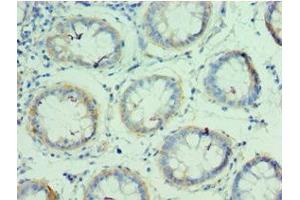 Immunohistochemistry of paraffin-embedded human colon cancer using ABIN7154026 at dilution of 1:100
