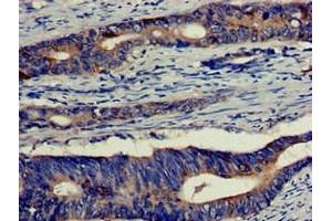 Immunohistochemistry of paraffin-embedded human colon cancer using ABIN7152180 at dilution of 1:100 (EIF4B 抗体  (AA 362-590))
