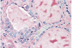 Human Thyroid (formalin-fixed, paraffin-embedded) stained with TG antibody ABIN396967 at 10 ug/ml followed by biotinylated anti-mouse IgG secondary antibody ABIN481714, alkaline phosphatase-streptavidin and chromogen. (Thyroglobulin 抗体)