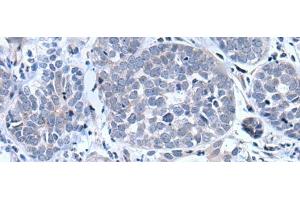 Immunohistochemistry of paraffin-embedded Human esophagus cancer tissue using BTG4 Polyclonal Antibody at dilution of 1:55(x200) (BTG4 抗体)