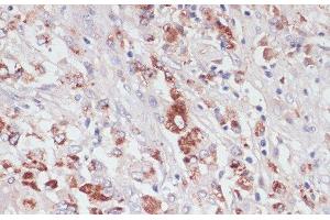 Immunohistochemistry of paraffin-embedded Human liver cancer using LYZ Polyclonal Antibody at dilution of 1:100 (40x lens). (LYZ 抗体)