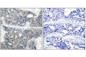 Immunohistochemical analysis of paraffin-embedded human breast carcinoma tissue using p70 S6 Kinase(Phospho-Thr421) Antibody(left) or the same antibody preincubated with blocking peptide(right).