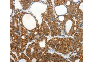 Immunohistochemistry of Human colon cancer using SLC12A4 Polyclonal Antibody at dilution of 1:30 (SLC12A4 抗体)