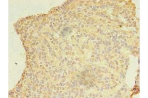Immunohistochemistry of paraffin-embedded human breast cancer using ABIN7174932 at dilution of 1:100 (CFAP92/KIAA1257 抗体  (AA 1-297))