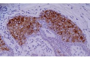 Immunohistochemistry staining of skin basaliom (paraffin-embedded sections) with anti-human Cytokeratin 10 (VIK-10). (Keratin 10 抗体)