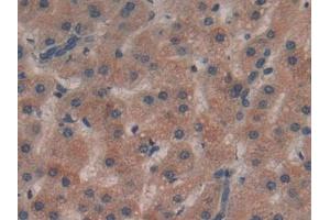Detection of PLXNB1 in Human Liver cancer Tissue using Polyclonal Antibody to Plexin B1 (PLXNB1)