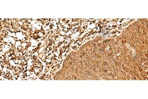 Immunohistochemistry of paraffin-embedded Human esophagus cancer tissue using FAM50A Polyclonal Antibody at dilution of 1:25(x200) (FAM50A 抗体)