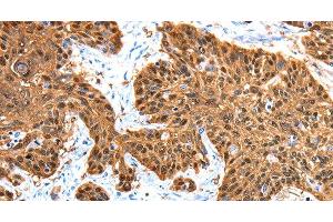 Immunohistochemistry of paraffin-embedded Human esophagus cancer using ADAMTS5 Polyclonal Antibody at dilution of 1:30 (ADAMTS5 抗体)