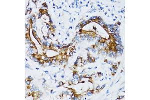 Immunohistochemistry of paraffin-embedded human colon carcinoma using MMP7 antibody. (MMP7 抗体)