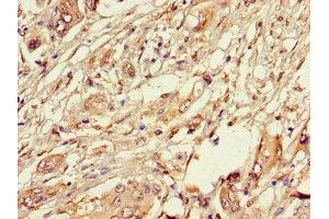 Immunohistochemistry of paraffin-embedded human pancreatic cancer using ABIN7162891 at dilution of 1:100 (PLIN3 抗体  (AA 192-324))