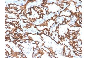 Formalin-fixed, paraffin-embedded human angiosarcoma stained with CD31 Mouse Monoclonal Antibody (PECAM1/3529). (CD31 抗体  (AA 625-738))