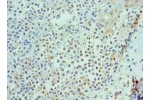 Immunohistochemistry of paraffin-embedded human breast cancer using ABIN7156850 at dilution of 1:100 (IL-21 抗体  (AA 25-162))