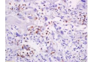 Formalin-fixed and paraffin embedded human lung carcinoma labeled with Anti-CD58/LFA-3 Polyclonal Antibody, Unconjugated  at 1:200 followed by conjugation to the secondary antibody and DAB staining. (CD58 抗体  (AA 31-130))