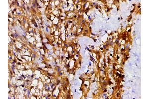 ABIN6267443 at 1/200 staining human meningeal carcinomatosis(MC) tissue sections by IHC-P. (Cofilin 抗体  (pSer3))