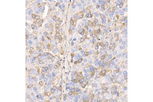 Immunohistochemistry of paraffin-embedded human liver cancer using RA/B Rabbit mAb (ABIN7269790) at dilution of 1:100 (40x lens). (RAB11A 抗体)