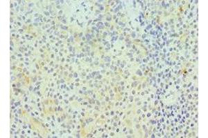 Immunohistochemistry of paraffin-embedded human breast cancer using ABIN7154414 at dilution of 1:100 (GZMA 抗体  (AA 29-262))