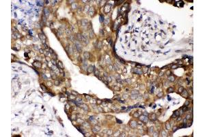 Anti- POR Picoband antibody,IHC(P) IHC(P): Human Mammary Cancer Tissue (POR 抗体  (C-Term))