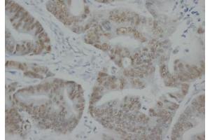 Immunohistochemistry (IHC) image for anti-Tumor Protein P53 (TP53) antibody (ABIN1108553)