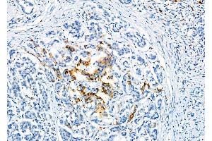 ABIN6263771 and ABIN6277122 at 1/100 staining Human pancreatic cancer and adjacent nomal tissues by IHC-P.