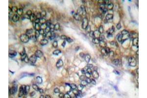 Immunohistochemistry analyzes of Separase antibody in paraffin-embedded human colon carcinoma tissue. (Separase 抗体)