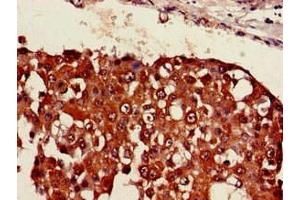 Immunohistochemistry of paraffin-embedded human breast cancer using ABIN7169405 at dilution of 1:100 (SESN1 抗体  (AA 224-337))