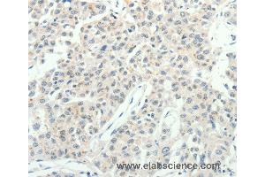 Immunohistochemistry of Human lung cancer using RPAP3 Polyclonal Antibody at dilution of 1:20 (RPAP3 抗体)