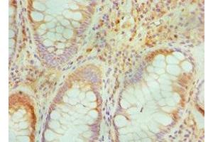 Immunohistochemistry of paraffin-embedded human colon cancer using ABIN7172842 at dilution of 1:100 (TGFBI 抗体  (AA 30-250))