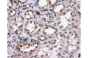 Immunohistochemical staining of paraffin-embedded Carcinoma of prostate tissue using anti-CISD1 mouse monoclonal antibody. (CISD1 抗体)