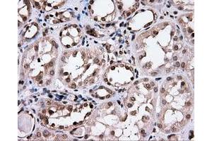 Immunohistochemical staining of paraffin-embedded Carcinoma of prostate tissue using anti-CISD1 mouse monoclonal antibody. (CISD1 抗体)