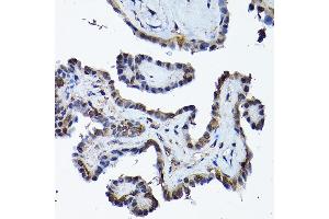 Immunohistochemistry of paraffin-embedded human thyroid cancer using PRMT5 Rabbit pAb (ABIN3022065, ABIN3022066, ABIN3022067 and ABIN6218592) at dilution of 1:200 (40x lens). (PRMT5 抗体  (AA 40-140))