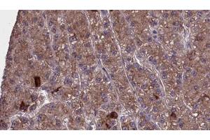 ABIN6273977 at 1/100 staining Human liver cancer tissue by IHC-P. (OR2H1 抗体  (C-Term))