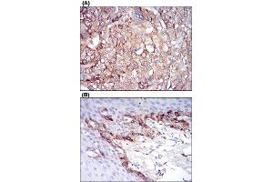 Immunohistochemical staining of human liver cancer tissues (A) and esophageal tissues (B) with FTL monoclonal antibody, clone 8E1E7  at 1:200-1:1000 dilution. (FTL 抗体)