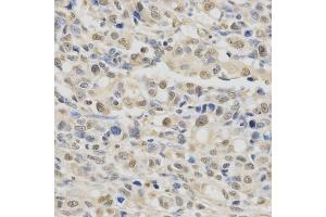 Immunohistochemistry of paraffin-embedded human gastric cancer using SPHK1 Antibody (ABIN5970017) at dilution of 1/200 (40x lens). (SPHK1 抗体)