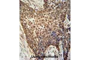 METTL4 antibody (C-term) immunohistochemistry analysis in formalin fixed and paraffin embedded human Lung carcinoma followed by peroxidase conjugation of the secondary antibody and DAB staining. (METTL4 抗体  (C-Term))
