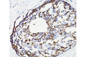 Immunohistochemistry of paraffin-embedded Human breast cancer using PDCD10 Polyclonal Antibody at dilution of 1:100 (40x lens).