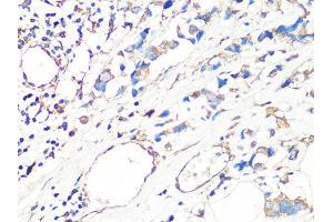 Immunohistochemistry of paraffin-embedded human breast cancer using MMP2 Antibody (ABIN4904395) at dilution of 1:100 (40x lens). (MMP2 抗体)