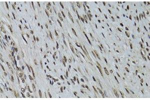 Immunohistochemistry of paraffin-embedded Human uterine cancer using LKB1 Polyclonal Antibody at dilution of 1:100 (40x lens). (LKB1 抗体)